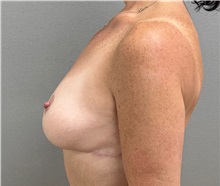Breast Lift After Photo by Keshav Magge, MD; Bethesda, MD - Case 50059