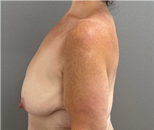Breast Lift Before Photo by Keshav Magge, MD; Bethesda, MD - Case 50059