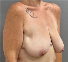 Breast Lift Before Photo by Keshav Magge, MD; Bethesda, MD - Case 50059