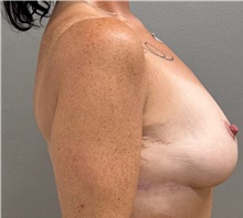 Breast Lift After Photo by Keshav Magge, MD; Bethesda, MD - Case 50059