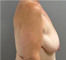 Breast Lift Before Photo by Keshav Magge, MD; Bethesda, MD - Case 50059