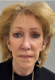Neck Lift After Photo by Keshav Magge, MD; Bethesda, MD - Case 50062