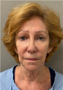 Neck Lift Before Photo by Keshav Magge, MD; Bethesda, MD - Case 50062