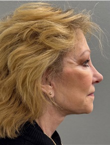 Neck Lift After Photo by Keshav Magge, MD; Bethesda, MD - Case 50062