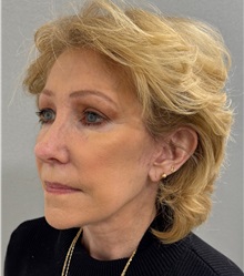 Facelift After Photo by Keshav Magge, MD; Bethesda, MD - Case 50061 Facelift After Photo by Keshav Magge, MD; Bethesda, MD - Case 50061
