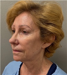 Facelift Before Photo by Keshav Magge, MD; Bethesda, MD - Case 50061 Facelift Before Photo by Keshav Magge, MD; Bethesda, MD - Case 50061