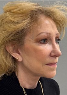 Facelift After Photo by Keshav Magge, MD; Bethesda, MD - Case 50061