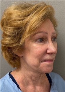 Facelift Before Photo by Keshav Magge, MD; Bethesda, MD - Case 50061