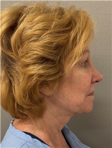 Facelift Before Photo by Keshav Magge, MD; Bethesda, MD - Case 50061