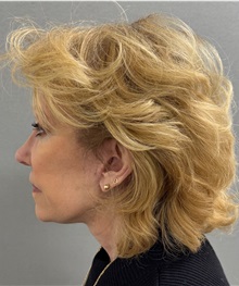 Facelift After Photo by Keshav Magge, MD; Bethesda, MD - Case 50061