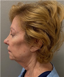 Facelift Before Photo by Keshav Magge, MD; Bethesda, MD - Case 50061