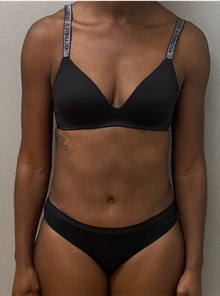 Tummy Tuck After Photo by Keshav Magge, MD; ,  - Case 50157