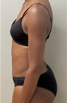 Tummy Tuck After Photo by Keshav Magge, MD; ,  - Case 50157