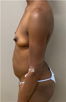 Tummy Tuck Before Photo by Keshav Magge, MD; ,  - Case 50157