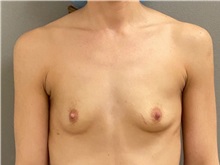 Breast Augmentation Before Photo by Keshav Magge, MD; ,  - Case 50174