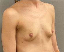 Breast Augmentation Before Photo by Keshav Magge, MD; ,  - Case 50174