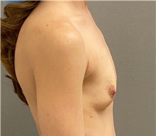 Breast Augmentation Before Photo by Keshav Magge, MD; ,  - Case 50174