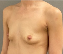 Breast Augmentation Before Photo by Keshav Magge, MD; ,  - Case 50174