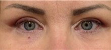Eyelid Surgery After Photo by Keshav Magge, MD; ,  - Case 50175