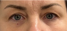 Eyelid Surgery Before Photo by Keshav Magge, MD; ,  - Case 50175