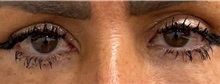 Eyelid Surgery After Photo by Keshav Magge, MD; ,  - Case 50196