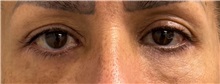Eyelid Surgery Before Photo by Keshav Magge, MD; ,  - Case 50196