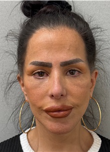 Facelift After Photo by Keshav Magge, MD; ,  - Case 50197