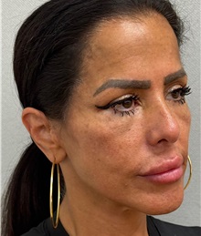 Facelift After Photo by Keshav Magge, MD; ,  - Case 50197