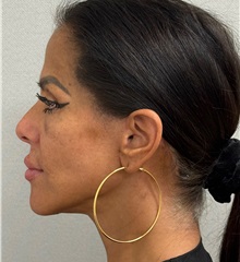 Facelift After Photo by Keshav Magge, MD; ,  - Case 50197