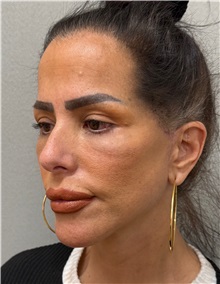 Neck Lift After Photo by Keshav Magge, MD; Bethesda, MD - Case 50198