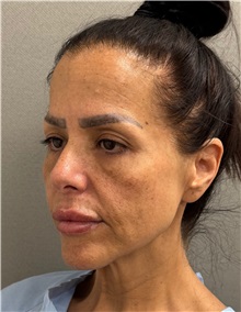 Neck Lift Before Photo by Keshav Magge, MD; Bethesda, MD - Case 50198