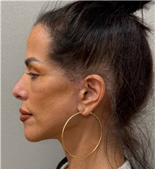 Neck Lift After Photo by Keshav Magge, MD; Bethesda, MD - Case 50198