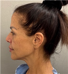 Neck Lift Before Photo by Keshav Magge, MD; Bethesda, MD - Case 50198