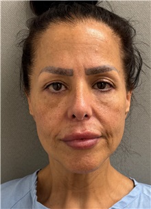 Neck Lift Before Photo by Keshav Magge, MD; ,  - Case 50198