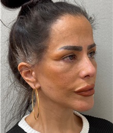Neck Lift After Photo by Keshav Magge, MD; Bethesda, MD - Case 50198