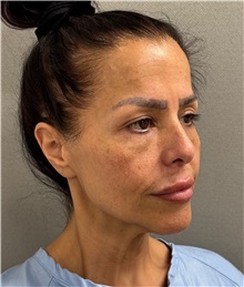 Neck Lift Before Photo by Keshav Magge, MD; Bethesda, MD - Case 50198