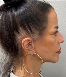 Neck Lift After Photo by Keshav Magge, MD; Bethesda, MD - Case 50198
