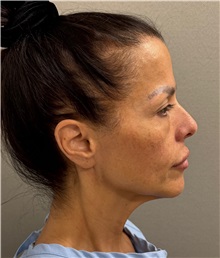 Neck Lift Before Photo by Keshav Magge, MD; Bethesda, MD - Case 50198