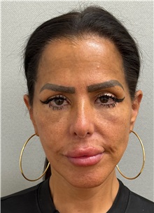 Neck Lift After Photo by Keshav Magge, MD; ,  - Case 50198