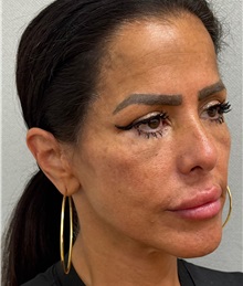 Neck Lift After Photo by Keshav Magge, MD; ,  - Case 50198