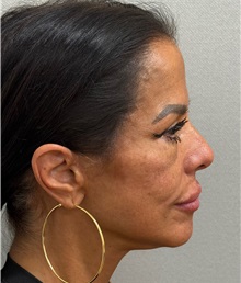 Neck Lift After Photo by Keshav Magge, MD; ,  - Case 50198