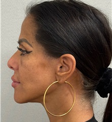 Neck Lift After Photo by Keshav Magge, MD; ,  - Case 50198