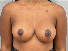 Breast Lift After Photo by Keshav Magge, MD; ,  - Case 50201
