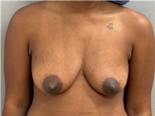 Breast Lift Before Photo by Keshav Magge, MD; ,  - Case 50201