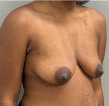 Breast Lift Before Photo by Keshav Magge, MD; ,  - Case 50201