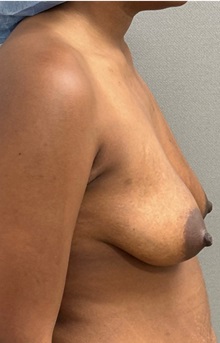 Breast Lift Before Photo by Keshav Magge, MD; ,  - Case 50201