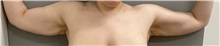 Arm Lift Before Photo by Keshav Magge, MD; ,  - Case 50204