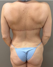 Body Lift After Photo by Keshav Magge, MD; ,  - Case 50203