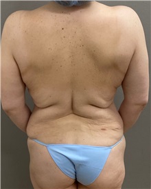 Body Lift Before Photo by Keshav Magge, MD; ,  - Case 50203