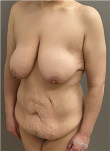 Mommy Makeover Before Photo by Keshav Magge, MD; ,  - Case 50207